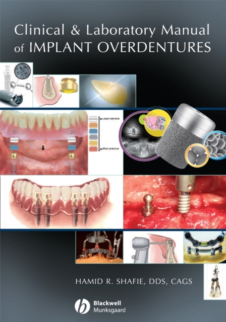 Clinical and Laboratory Manual of Implant Overdentures Shafie Hardback