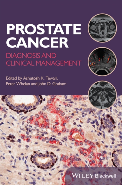Prostate Cancer – Diagnosis and Clinical Management Tewari Paperback