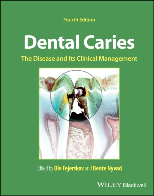 Dental Caries The Disease and its Clinical Management Fejerskov Fejerskov Nyvad