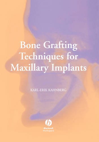 Bone Grafting Techniques for Maxillary Implants Kahnberg Hardback 9781405129947
