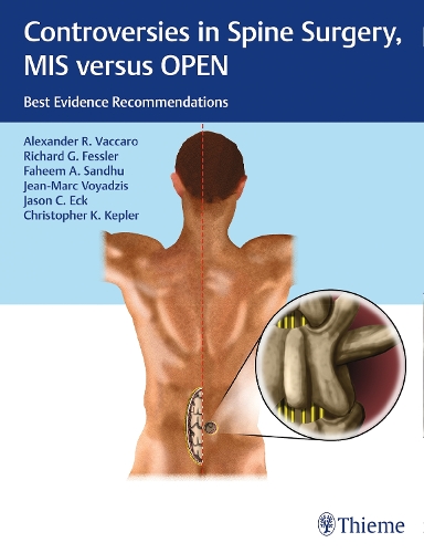 Controversies in Spine Surgery, MIS versus OPEN – Best Evidence Recommendations