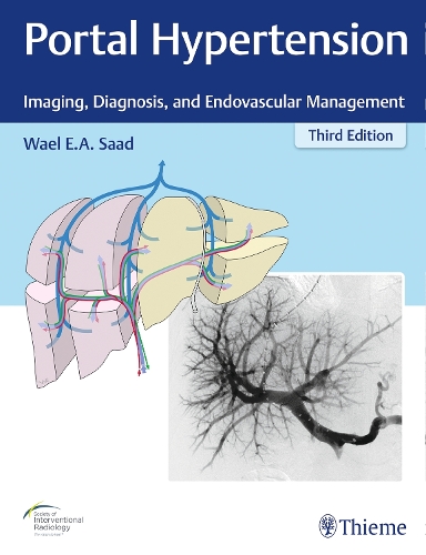 Portal Hypertension – Imaging, Diagnosis, and Endovascular Management Saad