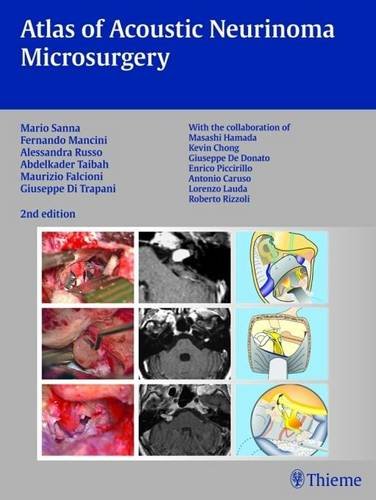 Atlas of Acoustic Neurinoma Microsurgery Sanna Hardback John Wiley & Sons