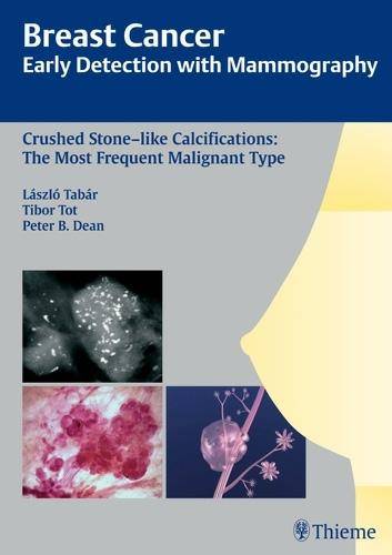 Breast Cancer: Early Detection with Mammography – Crushed Stone–like Calcificat…