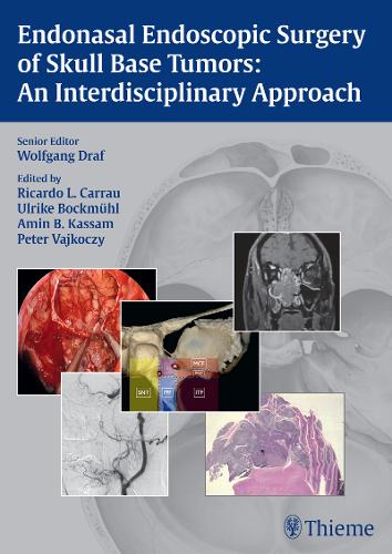 Endonasal Endoscopic Surgery of Skull Base Tumors: An Interdisciplinary Approac…