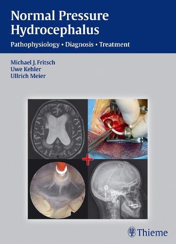 NPH – Normal Pressure Hydrocephalus – Pathophysiology – Diagnosis – Treatment