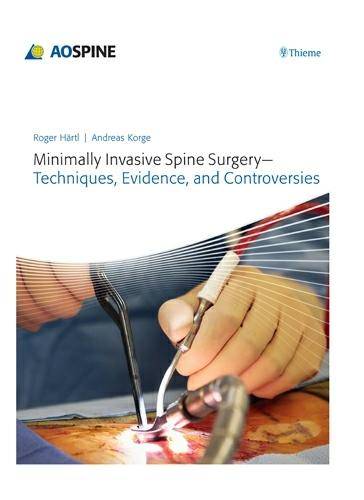 Minimally Invasive Spine Surgery – Techniques, Evi dence, and Controversies