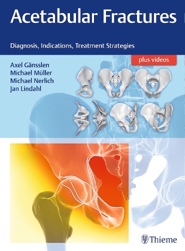 Acetabular Fractures – Diagnosis, Indications, Treatment Strategies Gänsslen