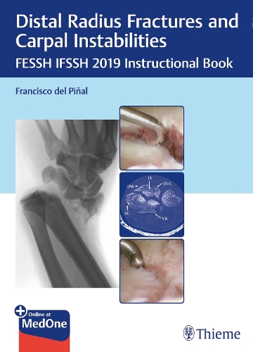 Distal Radius Fractures and Carpal Instabilities Pinal Paperback 9783132423794
